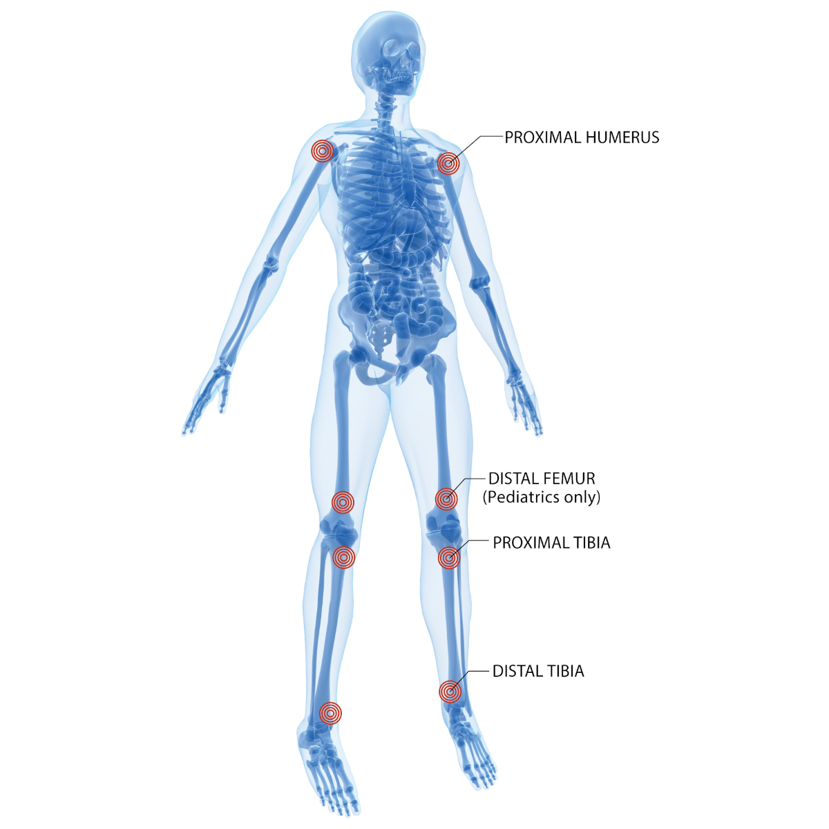Arrow® EZ-IO® Needle Set - 15 mm | Intraosseous Access | Emergency ...