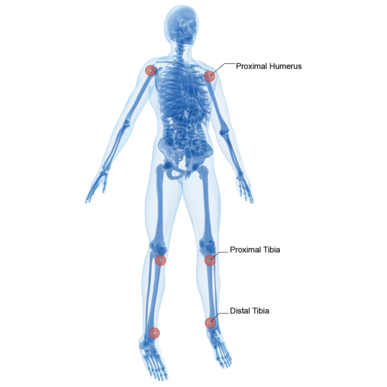 Arrow® EZ-IO® Manual Needle Set